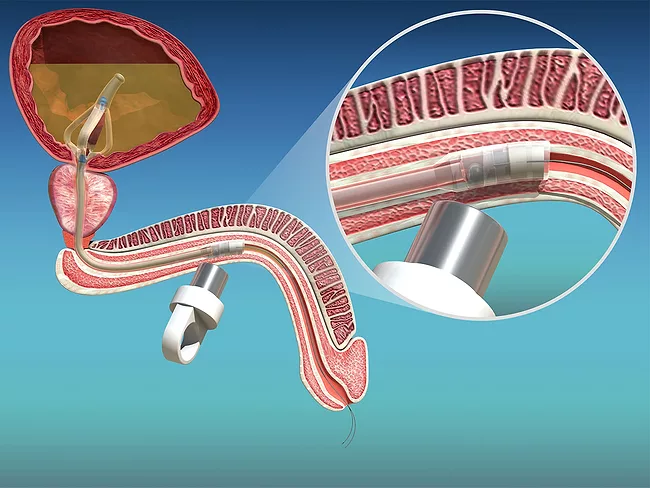UroDev Medical brand asset featured on bioworld.com